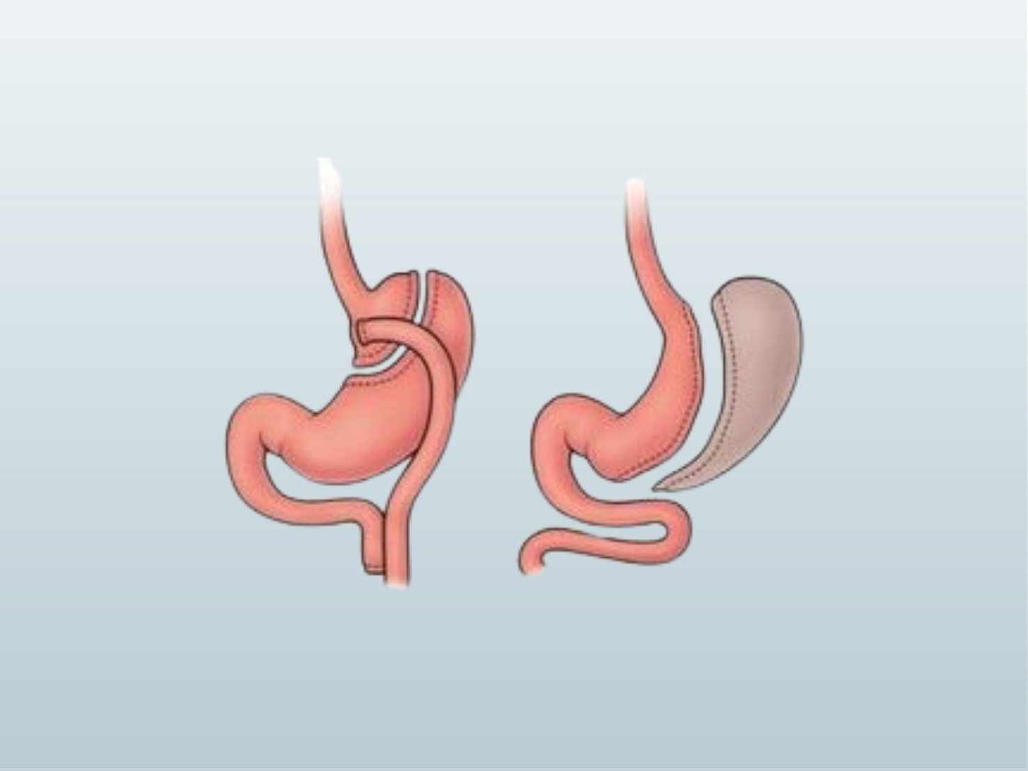 Prof. Dr. Ahmet Gökhan Türkçapar’ın Hastane Vizitlerinden İzlenimler: Obezite ve Metabolik Cerrahi